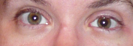 eyes dilation side effect